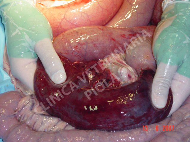 Strangolamento da lipoma peduncolato 5